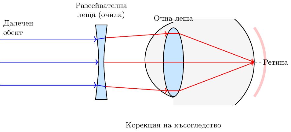 Геометрична диаграма, илюстрираща късогледство и неговата корекция. Диаграмата включва централна хоризонтална оптична ос.
**Некоригирано състояние:** В горната част на диаграмата е показан опростен напречен разрез на очна ябълка, ориентирана хоризонтално. Отляво, две или три успоредни светлинни лъча (представляващи далечен обект) навлизат в окото. Те преминават през вътрешна биконвексна очна леща. Лъчите се пречупват и се фокусират в една точка, разположена *пред* извитата задна повърхност на ретината. Светлинните лъчи да са със стрелки, показващи посоката им. Етикети: 'Оптична ос', 'Очна леща', 'Ретина', 'Фокус пред ретината'.
**Коригирано състояние:** В долната част на диаграмата, под некоригираното състояние, е показан идентичен напречен разрез на очна ябълка. Отляво, пред очната ябълка, е поставена външна вдлъбната (разсейвателна) леща. Две или три успоредни светлинни лъча навлизат отляво, преминават първо през външната вдлъбната леща, която ги разсейва леко. След това тези леко разсеяни лъчи навлизат в очната леща на окото, която ги пречупва и ги фокусира *точно върху* задната извита повърхност на ретината. Светлинните лъчи да са със стрелки. Етикети: 'Оптична ос', 'Вдлъбната (разсейвателна) леща', 'Очна леща', 'Ретина', 'Фокус върху ретината'.
Всяка очна ябълка да е приблизително сферична, с по-изпъкнала предна част, имитираща роговицата.